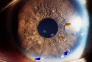Ocular syphilis 