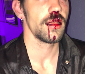 This photo of Cory Stedman taken after the assault has been heavily edited out of respect for his privacy.